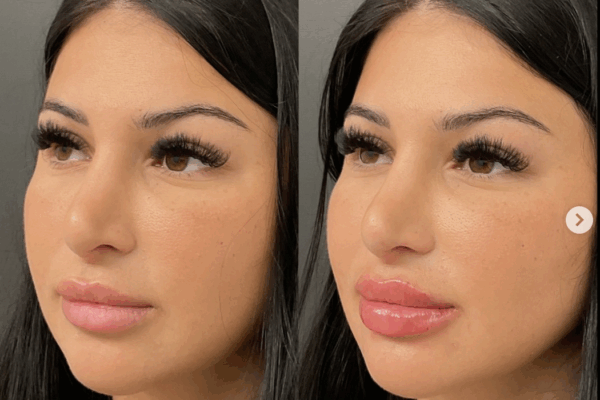 lip filler in tampa